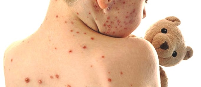 Epidemia  di morbillo in Piemonte
