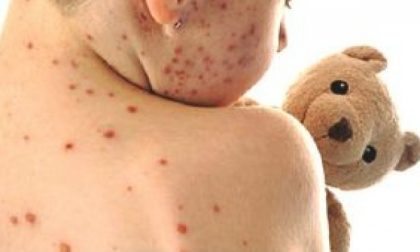 Morbillo, 161 casi in poche settimane