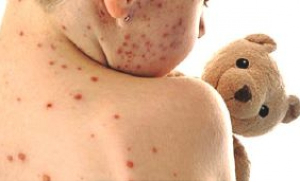 Morbillo, 161 casi in poche settimane