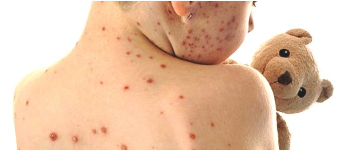 Bambini all’asilo solo se vaccinati