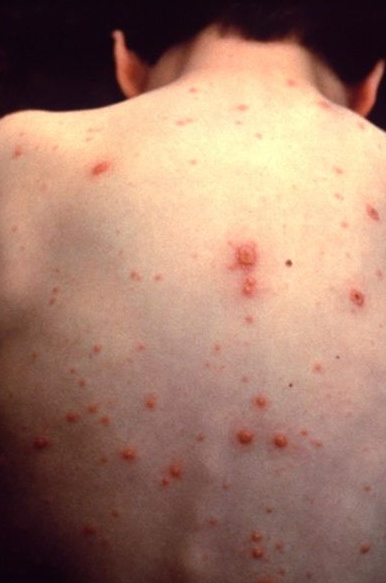 Morbillo, l’epidemia in Piemonte