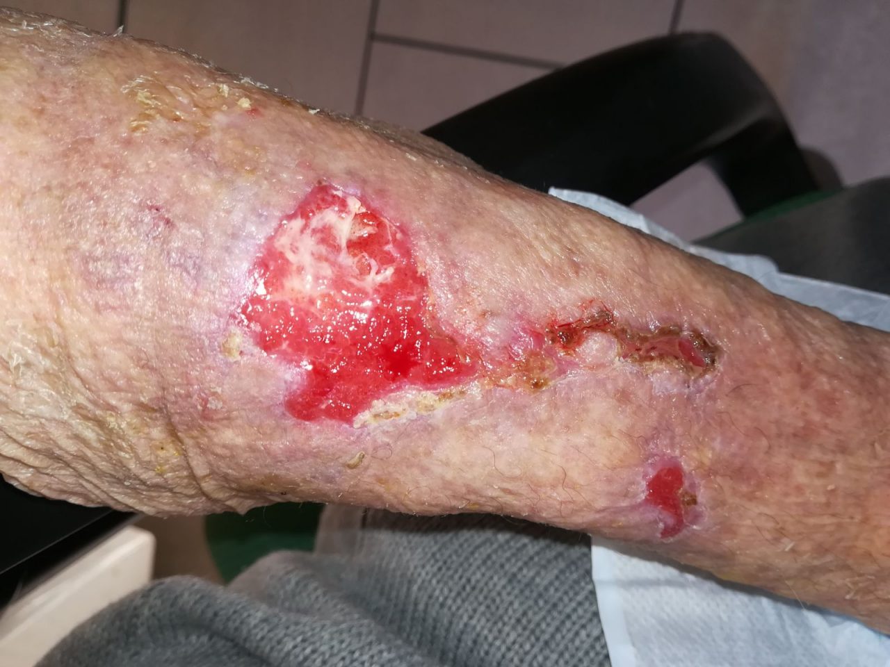 Anziana portata in ospedale per bronchite aveva “un’infezione” al braccio