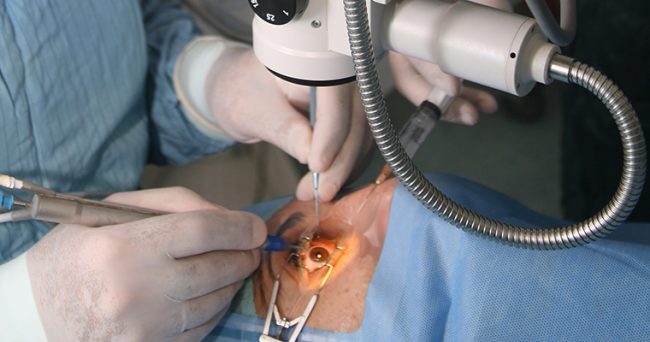 Operate di cataratta quattro donne perdono un occhio a Torino