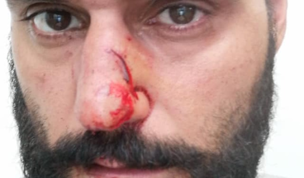 Colpito al volto dallo specchietto dopo un incidente: caccia all’uomo