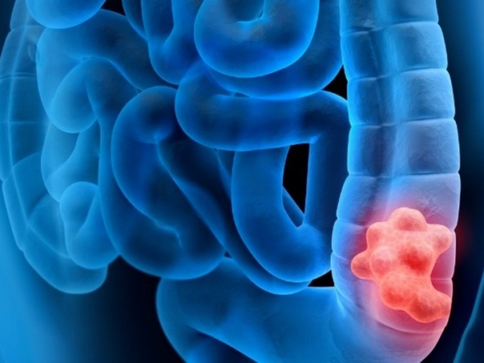 Screening dei tumori del colon-retto, offerto gratuitamente il test