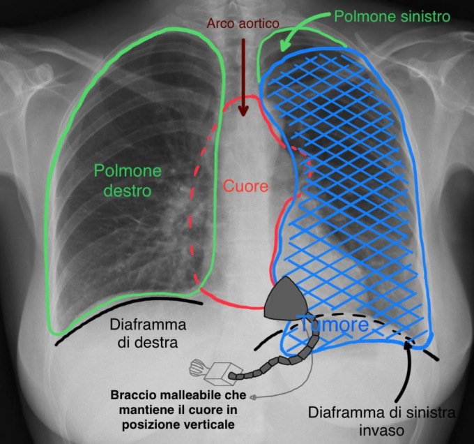 Uomo con  tumore tra cuore e polmone salvo grazie ad un intervento all’ospedale Molinette